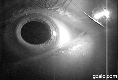 Eye under IR light